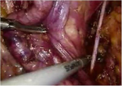 Comparative study of each surgical step in radical prostatectomy under 3D and 2D laparoscopy